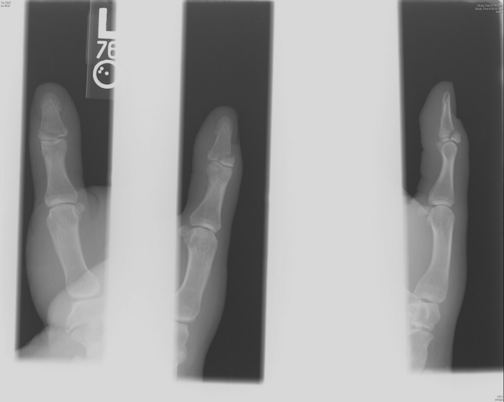 ( xRay "Closed Mallet Finger Fracture" (left thumb) als pictures