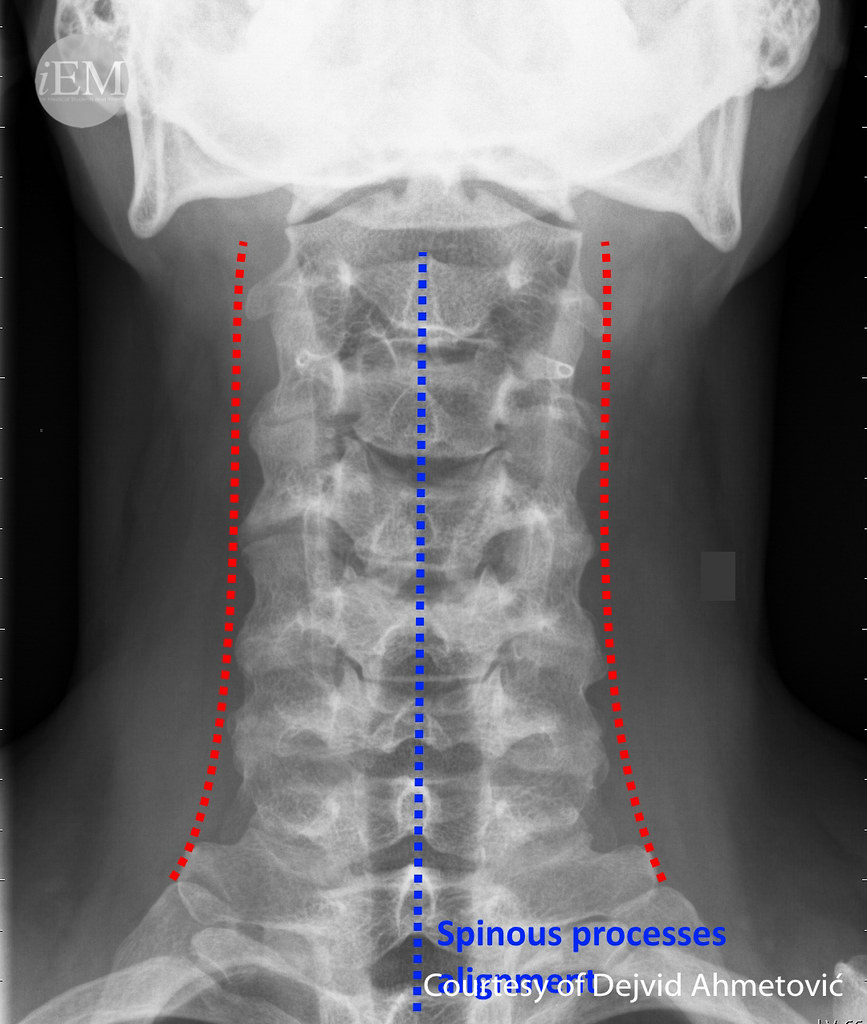 anteroposterior cspine Figure 11 Blue line connects th… Flickr