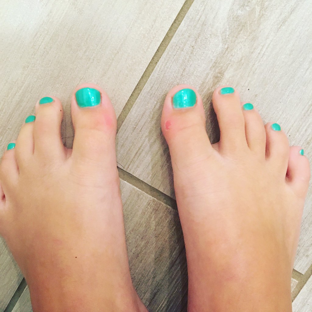 Blisters from lots of kicking with fins at swim team pract… Flickr