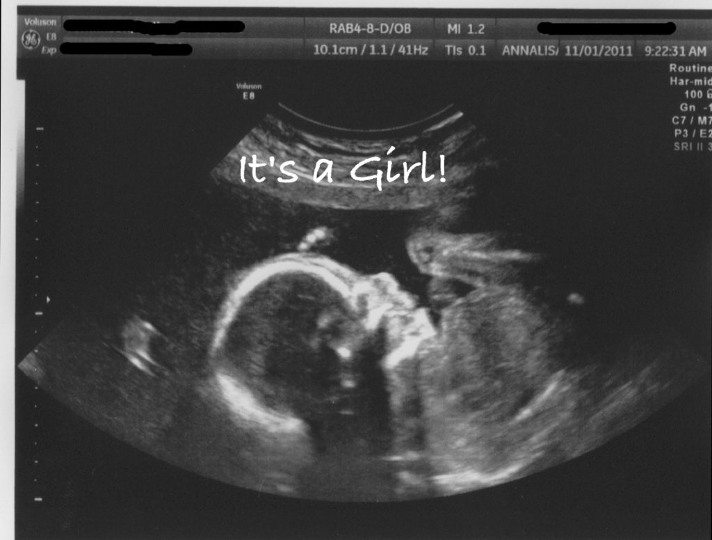 20 Week Anatomy Scan and Gender Results Ultrasound Picture