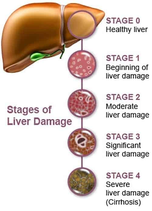 Liver Cirrhosis Stages