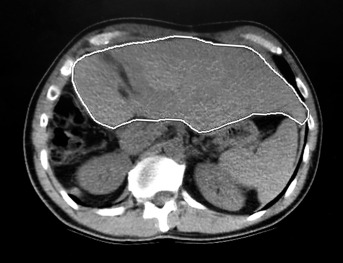 Living Liver Donation Surgery Journal One Year Later Liver Givers