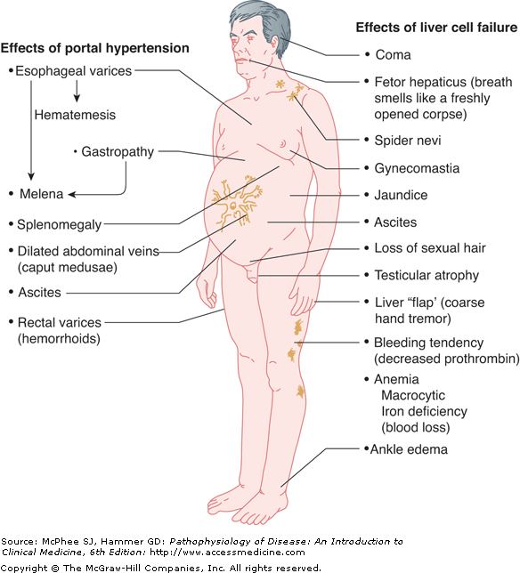 What Is Ascites? Livers With Life Living With Liver Disease