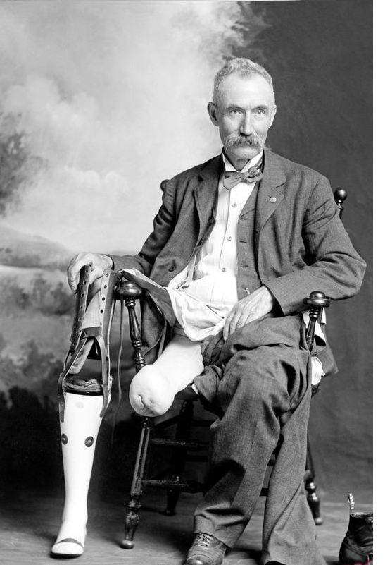 The Hanger Prosthetic Leg Turns 149 Years Old Amplitude