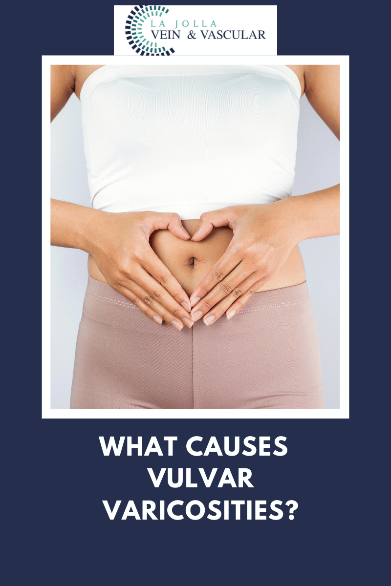 What Causes Vulvar Varicosities?