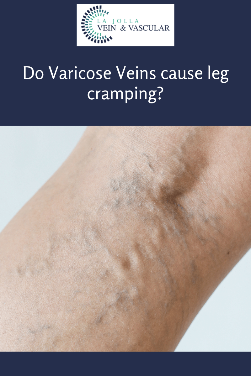 Do varicose veins cause leg cramps?