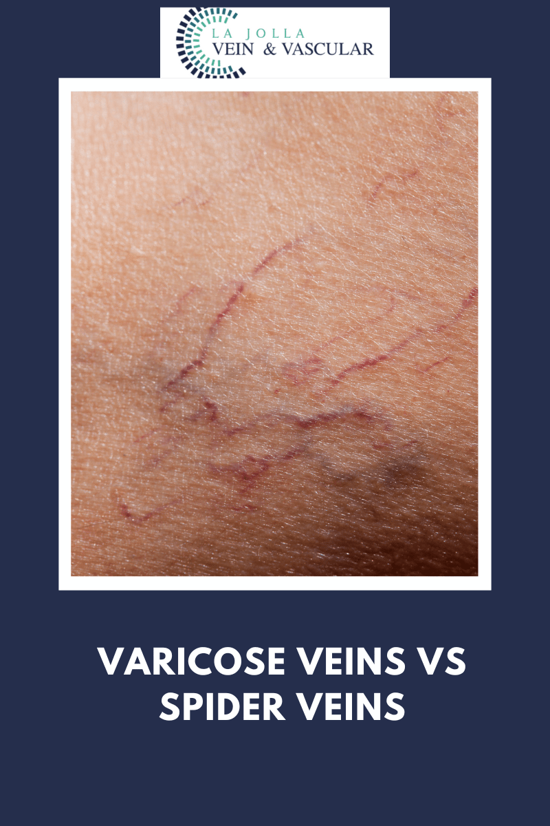 Vein & Vascular Treatment Vein and Vascular Care Clinic La Jolla, CA