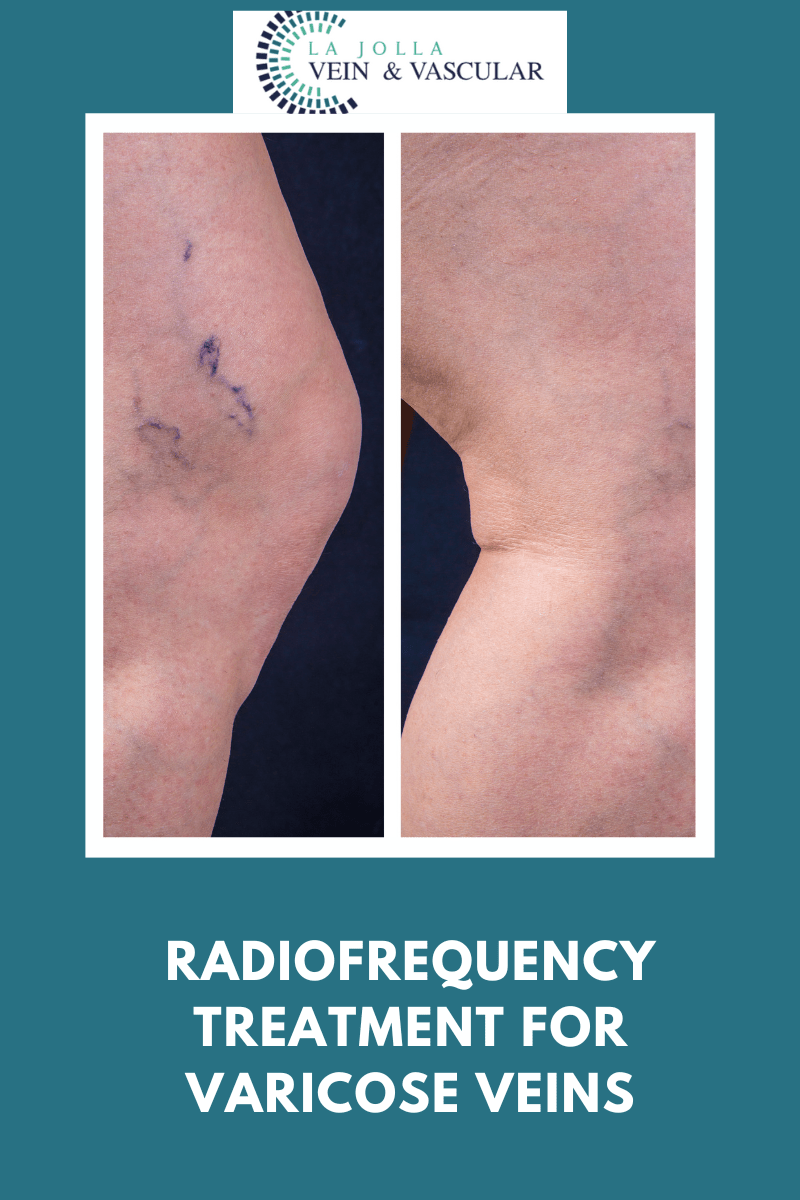 Radiofrequency for Varicose Veins