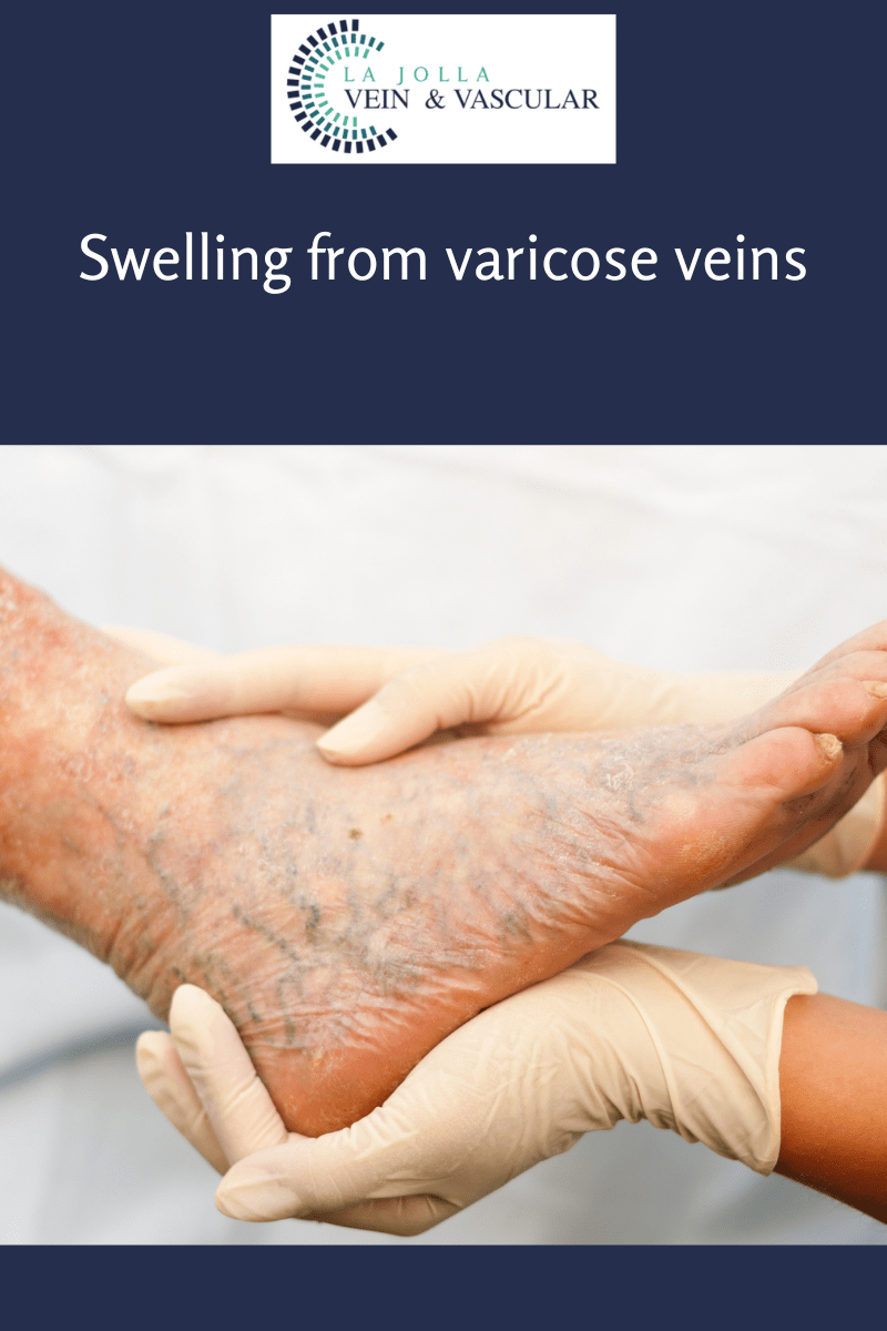 Swelling and varicose veins