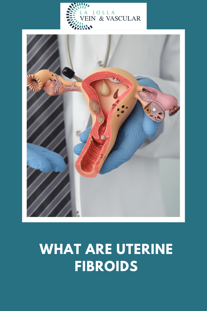 Vein & Vascular Treatment Uterine Fibroids