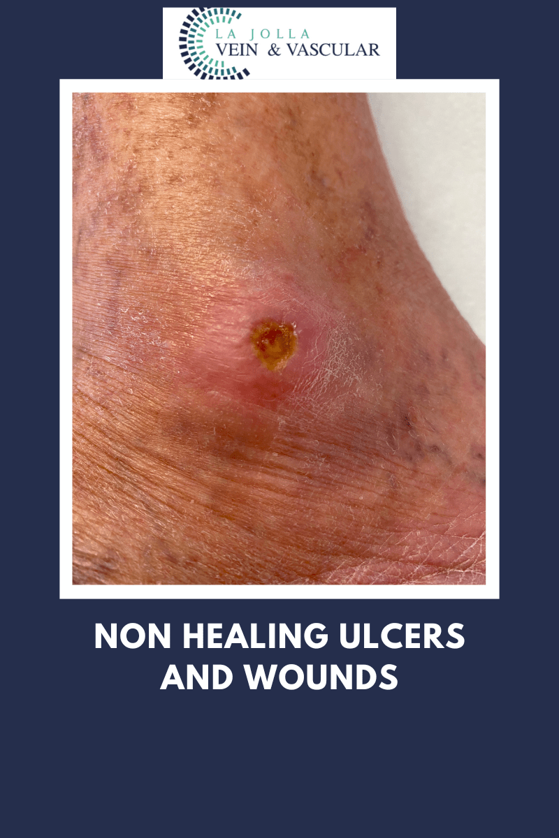 Vein & Vascular Treatment Ulcers & Wound Care