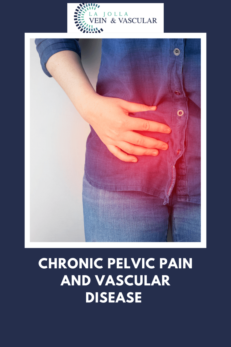Vein & Vascular Treatment Chronic Pelvic Pain