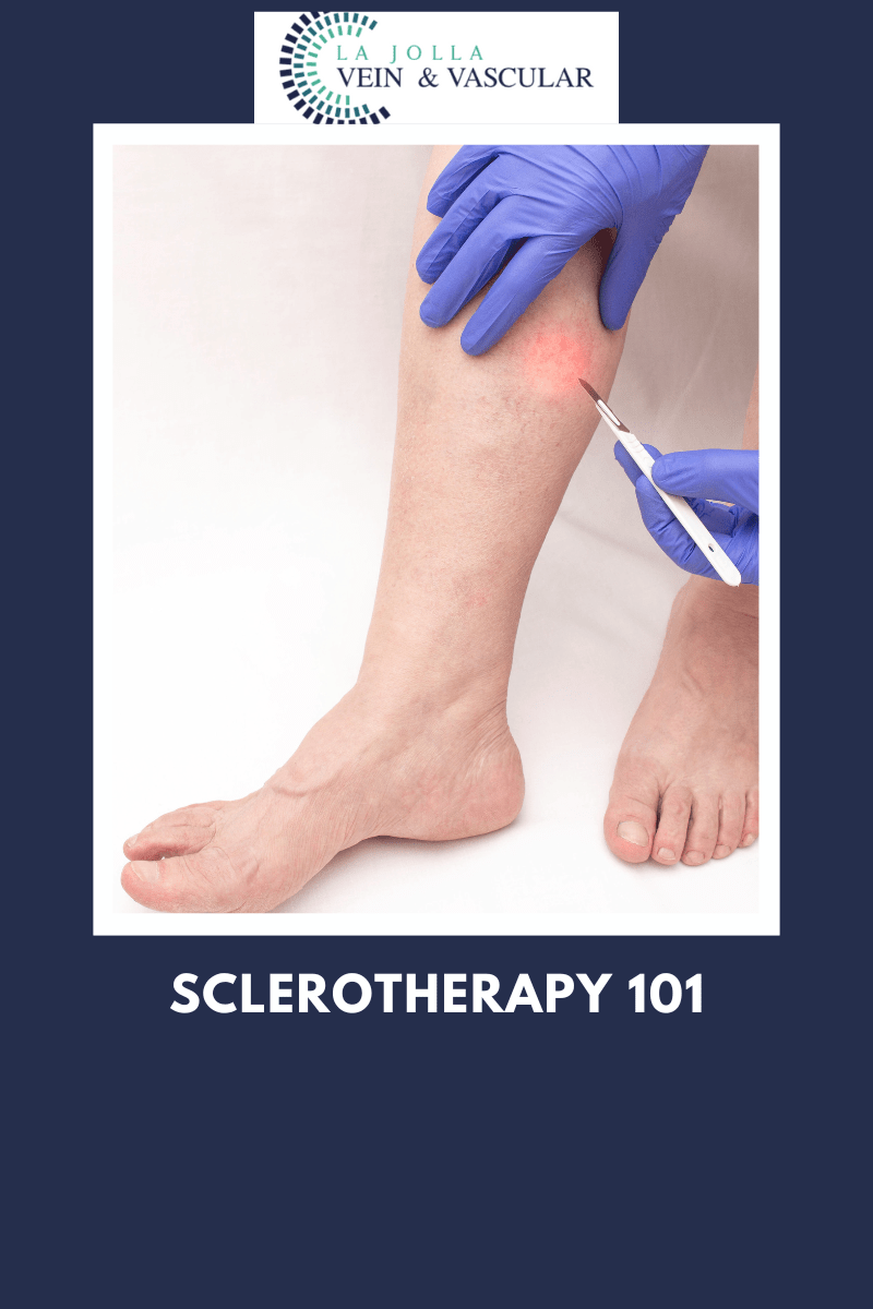 Vein & Vascular Treatment Sclerotherapy