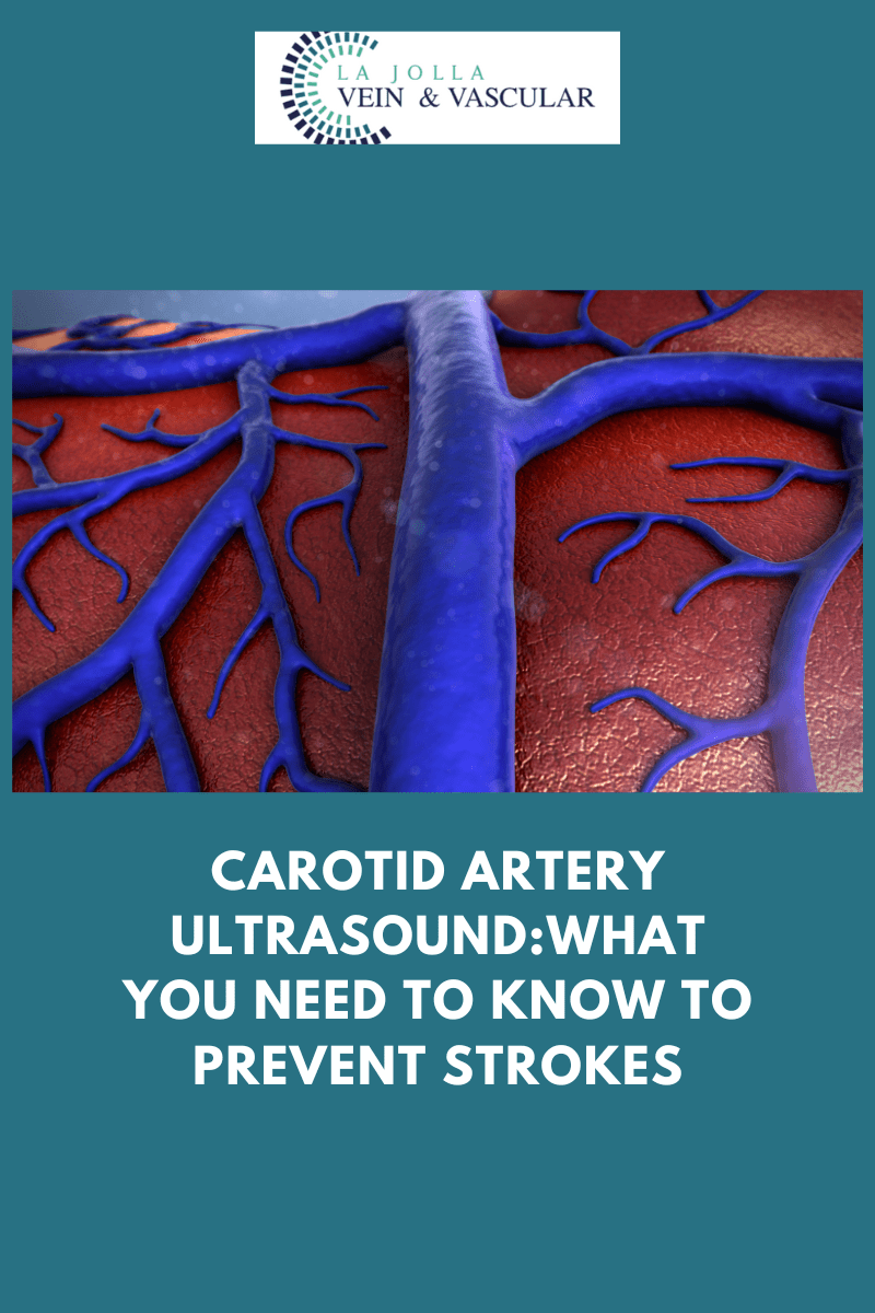 Vein & Vascular Treatment Carotid Artery