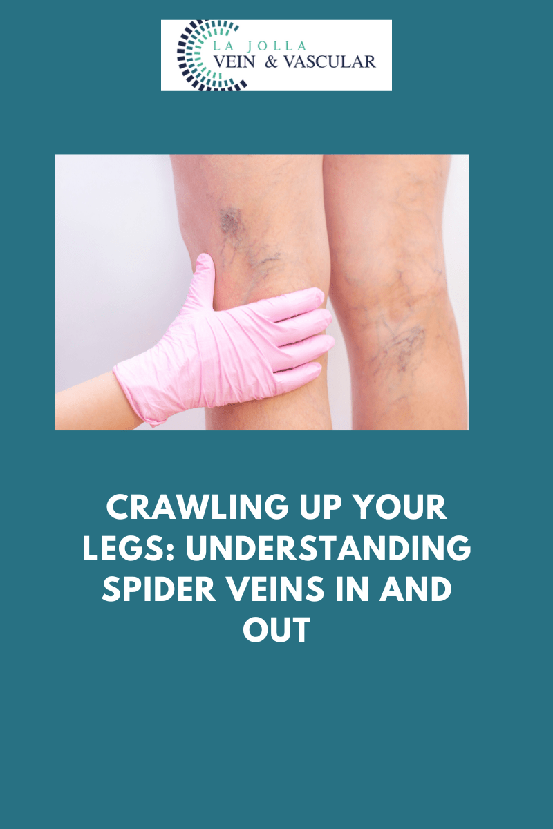 Vein & Vascular Treatment Spider Veins