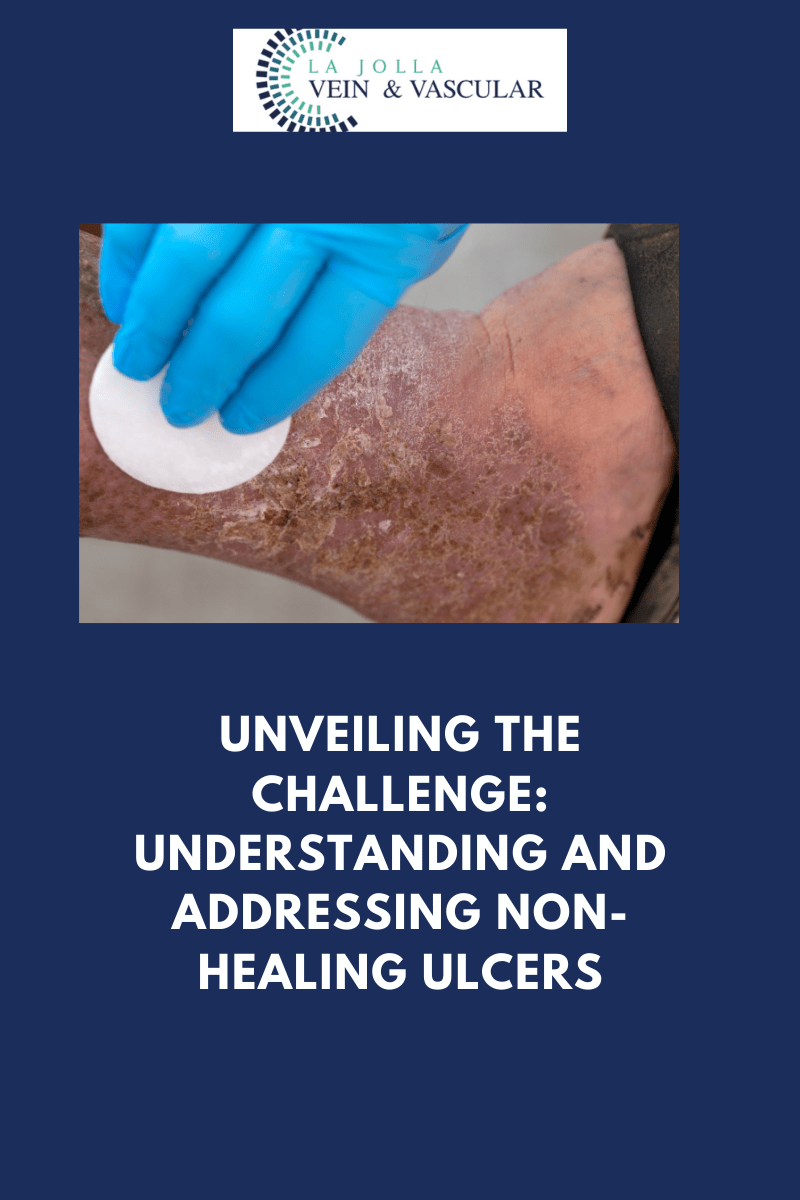 Vein Treatments Archives La Jolla Vein & Vascular Accredited Center