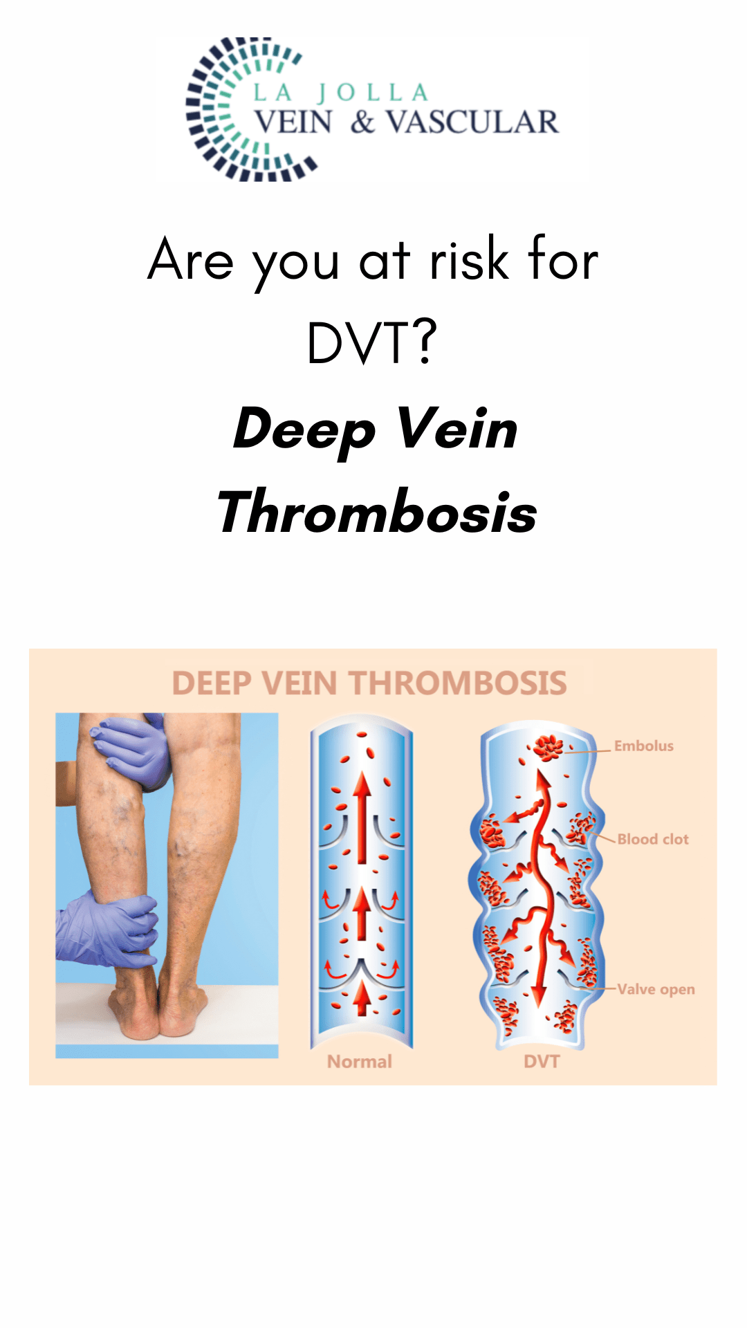 Risk for Deep Venous Thrombosis Learn DVT Risk Factors