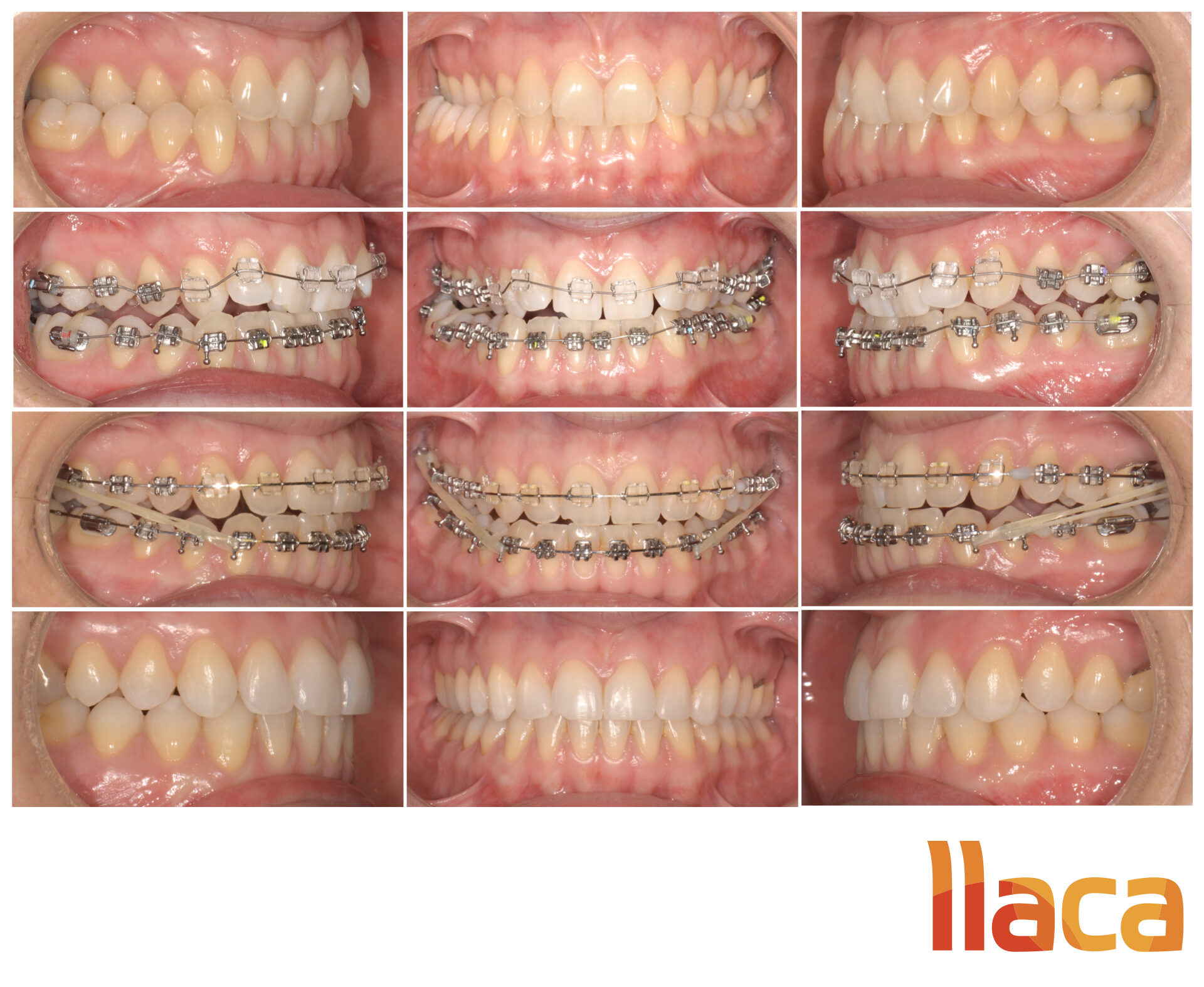 Brackets Zafiro Los Brackets Transparentes LLACA ortodoncia Oviedo