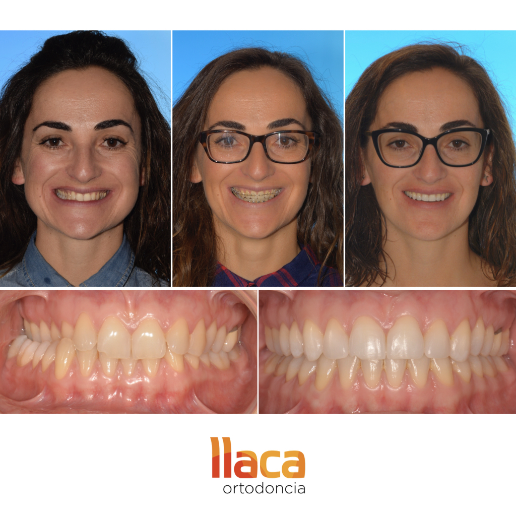 Brackets Zafiro Los Brackets Transparentes LLACA ortodoncia Oviedo