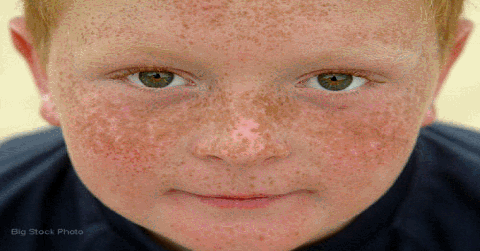 What's Prettier Than Freckles?