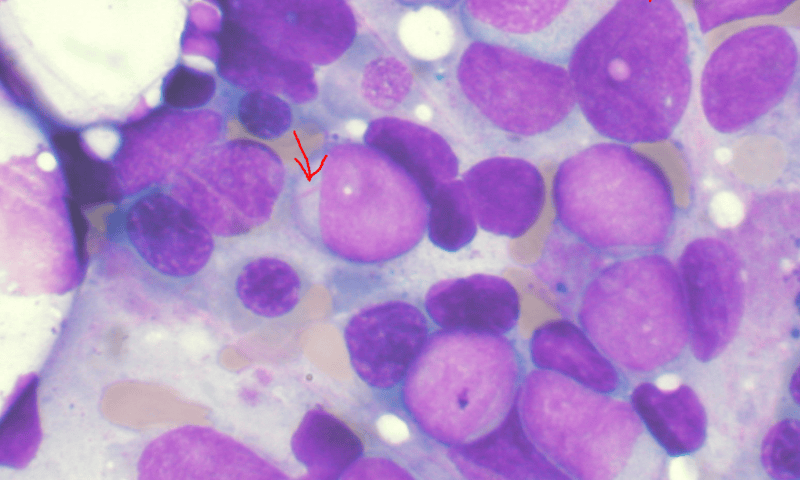 Study leads to breakthrough in better understanding acute myeloid