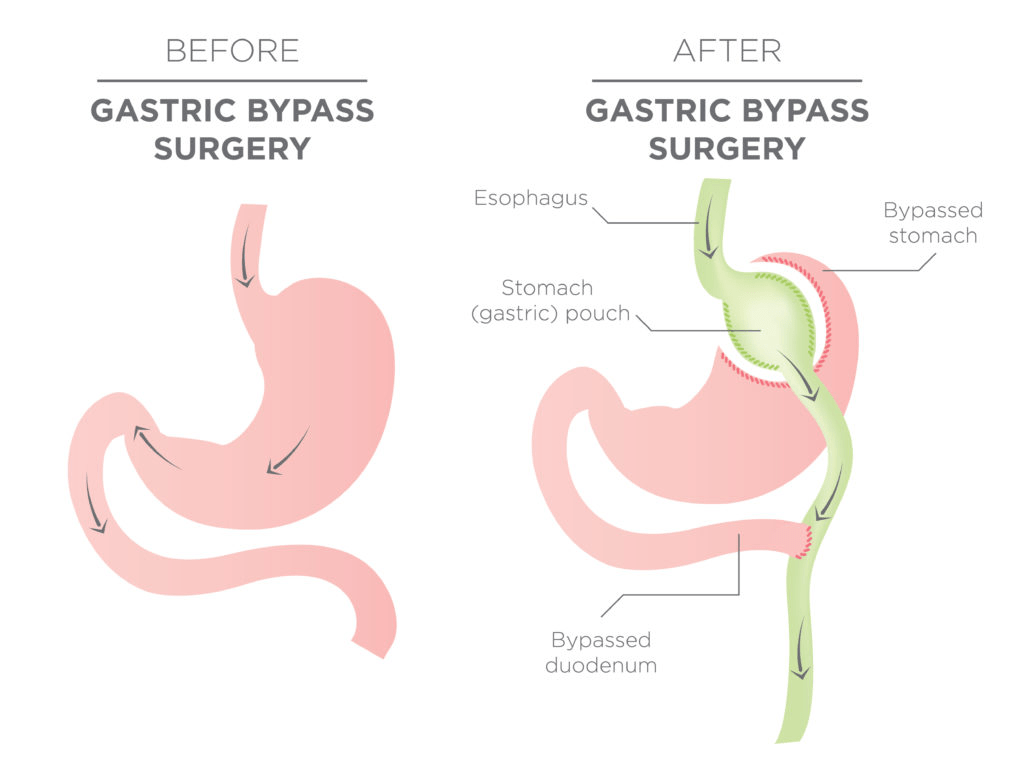 Drinking alcohol after surgery when, how much and what Lock 7