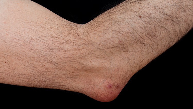 Bursitis olecrani Orthopäde Wien Ordination Dr. Clemens Hüthmair