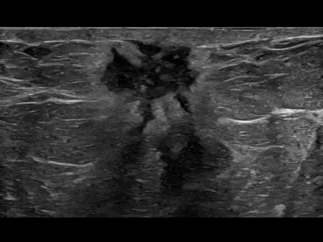 Breast ultrasound Personalised breast care LOGIQ™