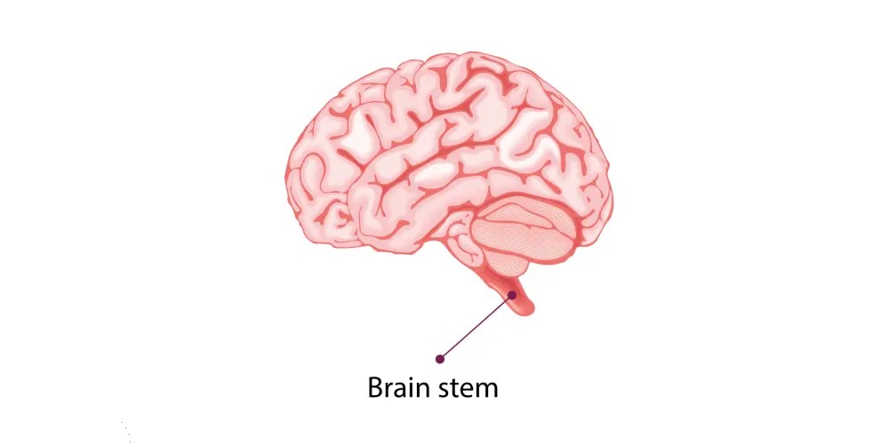 5 Types Of Stroke Symptoms, Causes And How To Treat