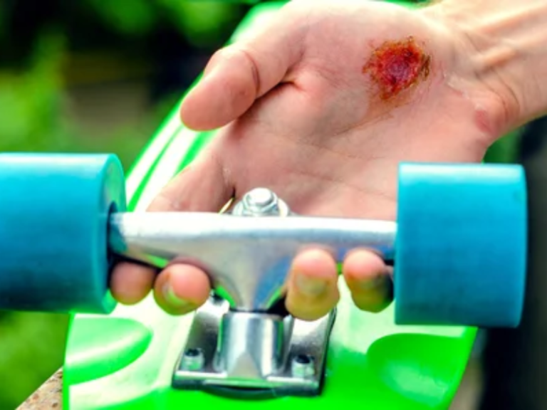 What are the Common Longboard Injuries?