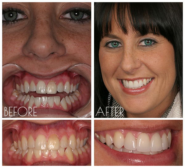 Cosmetic Tooth Fillings in Carthage, Watertown, Fortdrum Long Falls