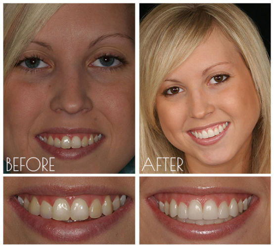 Cosmetic Tooth Fillings in Carthage, Watertown, Fortdrum Long Falls