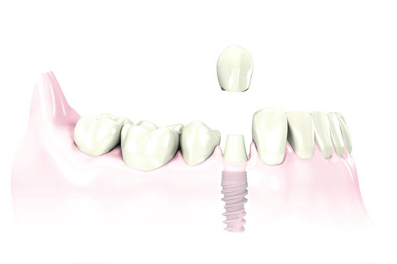 Dental Implants in Carthage, Watertown, Fortdrum Long Falls Dentistry