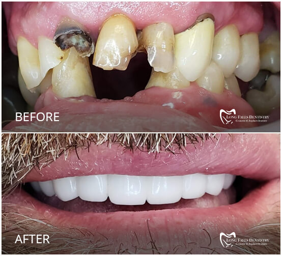 Unique Dental Implant Process Long falls Dentistry of Carthage NY