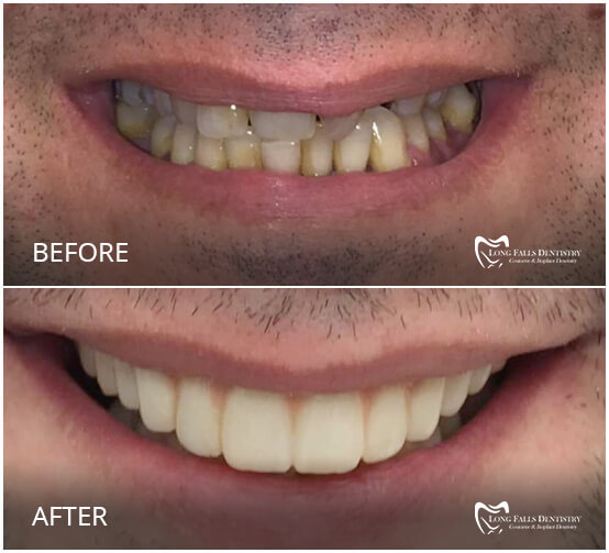 Take A Look At Our Smile Gallery Long Falls Dentistry