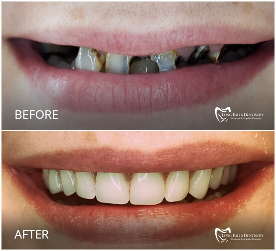 Take A Look At Our Smile Gallery Long Falls Dentistry