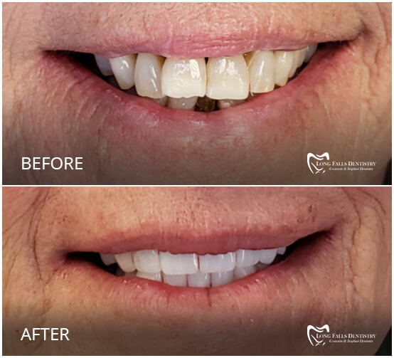 Take A Look At Our Smile Gallery Long Falls Dentistry