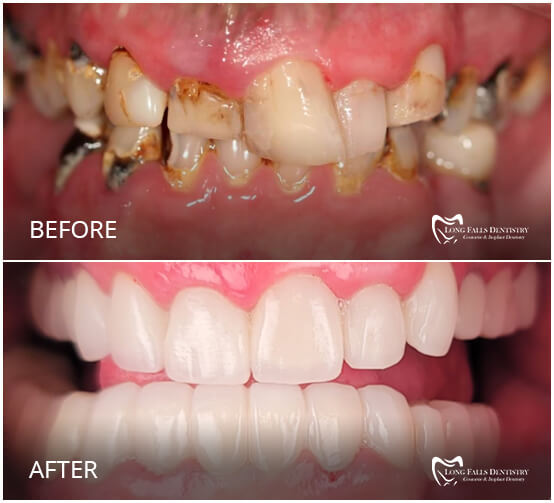 Dentist in Carthage NY, Watertown, Fortdrum Long Falls Dentistry