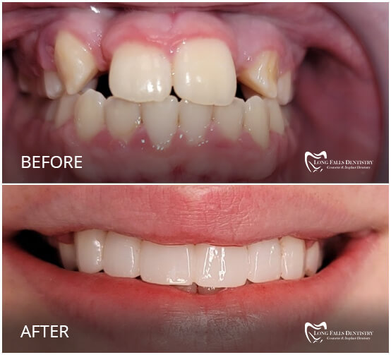 Dentist in Carthage NY, Watertown, Fortdrum Long Falls Dentistry