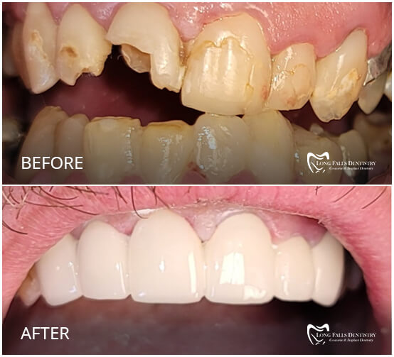 Deep Cleaning Can Develop the Condition of Your Gums, Know Why it is