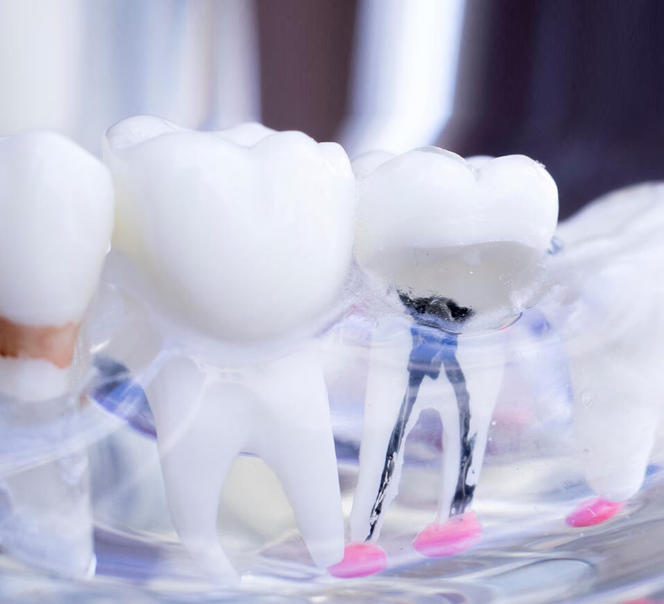 Root Canal Therapy in Carthage & Watertown Long Falls Dentistry