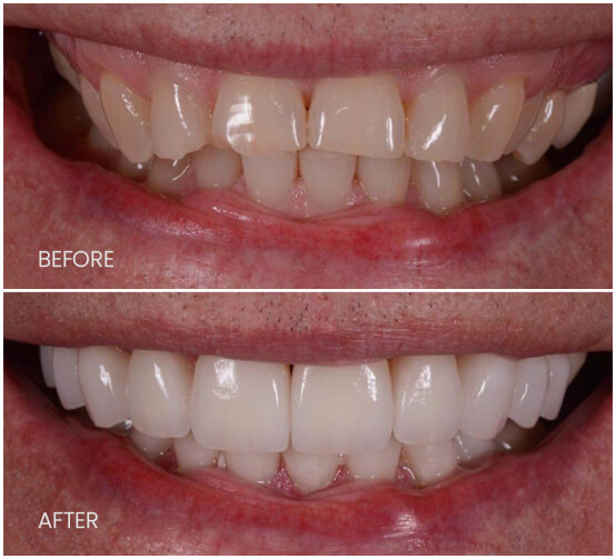 Porcelain Veneers in Carthage, Watertown, Fortdrum Long Falls Dentistry