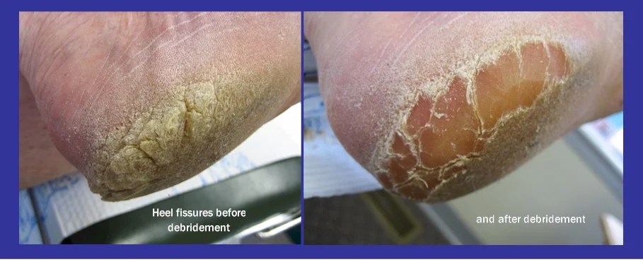 Tips To Avoid Cracked Heels Homemade Beauty Remedies