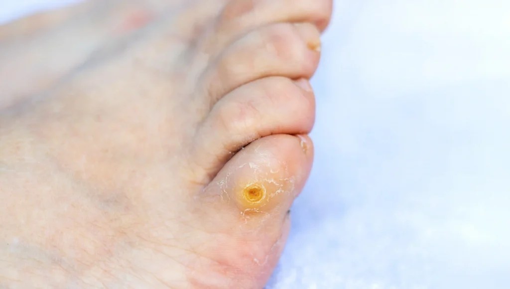 What Does a Corn Look Like After Removed? Pictorial Guide