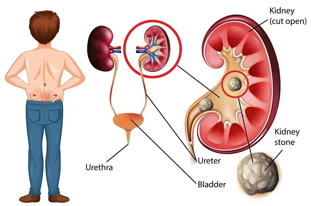 Stages of Passing a Kidney Stone How Long It Takes to Pass