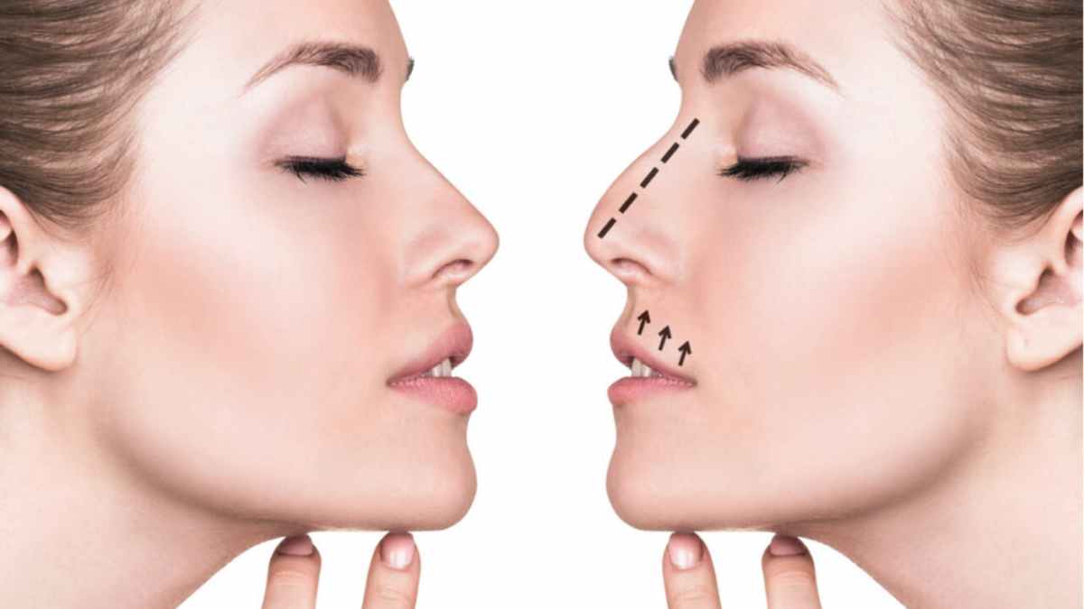 What to Expect During a Rhinoplasty Procedure Loop21