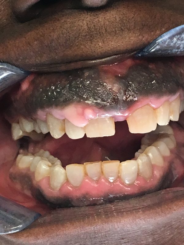 Black Gums & Dark Gums Loop Perio