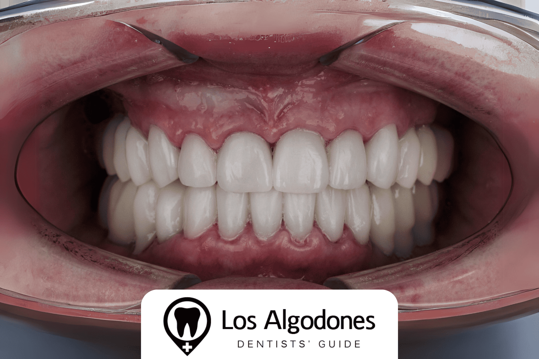 Dental Crowns Prices in Los Algodones vs. Dental Crowns in the USA