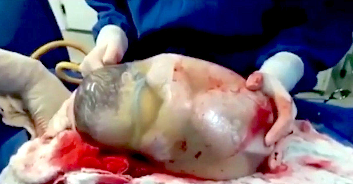Nurse Films The Rare Moment A Baby Is Born Inside A Fully Intact
