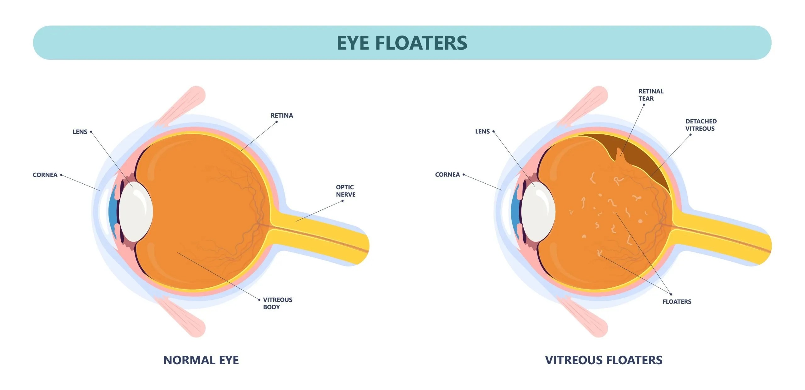 Understanding Eye Floaters Causes, Meaning, and Treatment Options